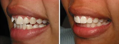 Six Month Smiles